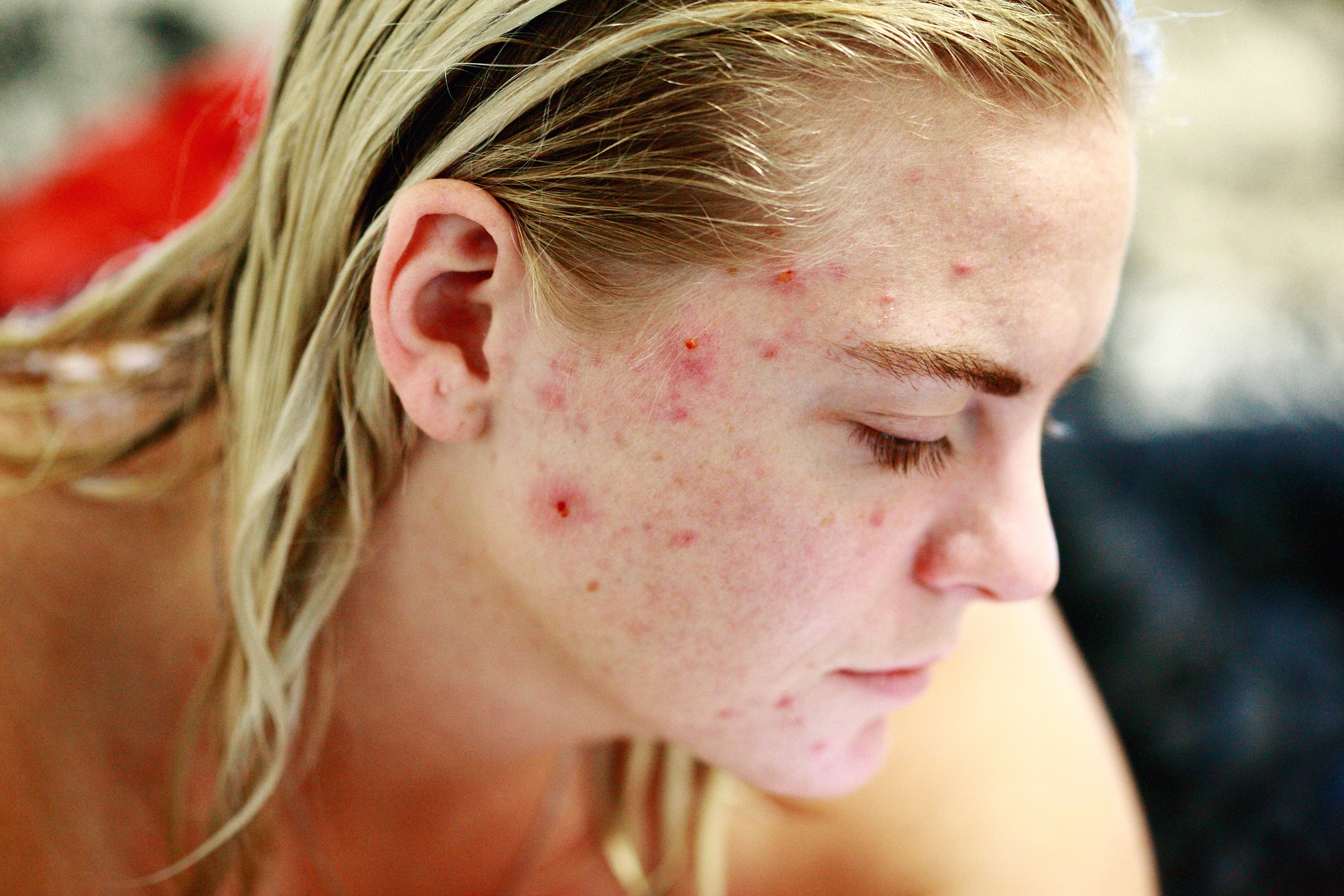 20 Best Natural Remedies for Acne