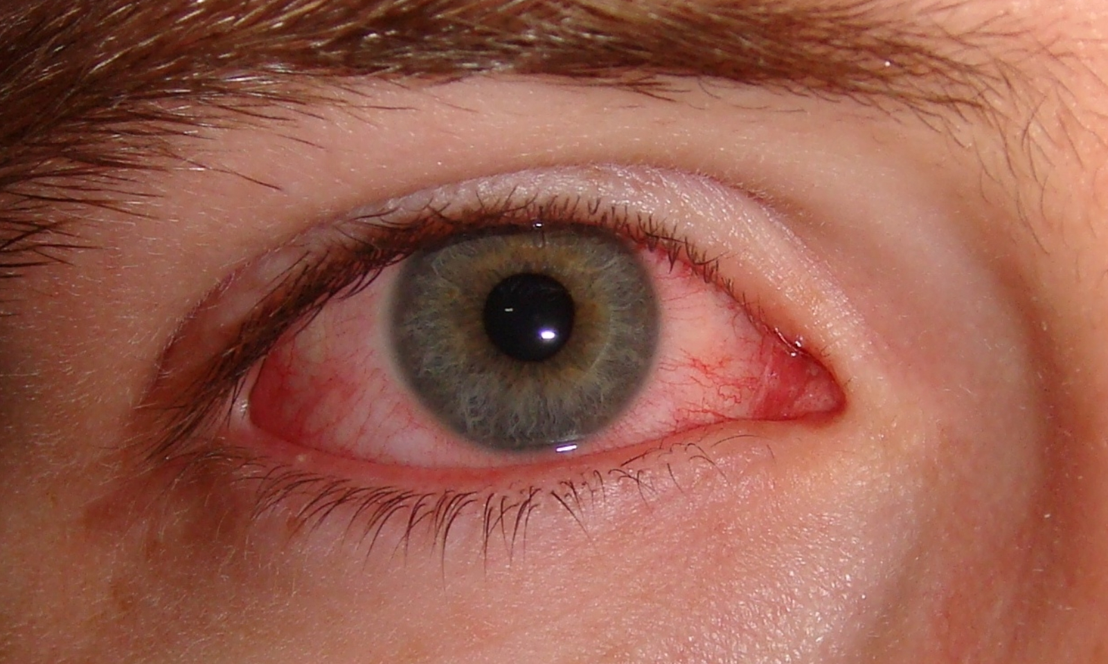20 Effective Natural Remedies to Cure Pinkeye