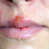 21 Effective Home Remedies to Cure Herpes
