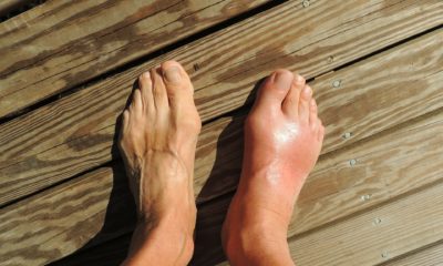 15 Natural Remedies to Get Relief from Gout Pain