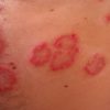 20 Research-backed Natural Remedies to Cure Eczema