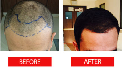 Hair Transplant - All You Want To Know