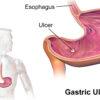 Stomach Ulcer - Causes Symptoms and Treatment!