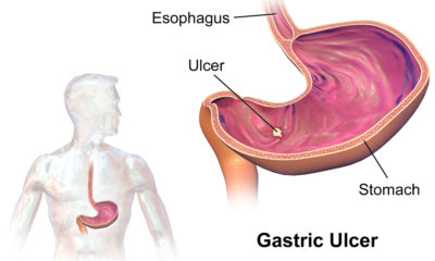 Stomach Ulcer - Causes Symptoms and Treatment!