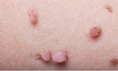 20 Simple & Effective Home Remedies for Skin Tag Removal
