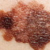 10 Effective Natural Remedies for Melanoma - Skin Cancer