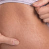 17 Effective Home Remedies to Get Rid of Stretch Marks
