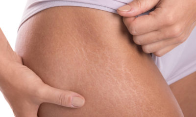 17 Effective Home Remedies to Get Rid of Stretch Marks