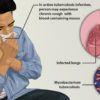 22 Effective Home Remedies for Tuberculosis