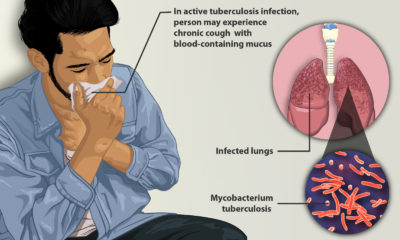22 Effective Home Remedies for Tuberculosis
