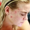 Acne-fighting Healthy Diet Tips for Vegetarians