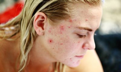 Acne-fighting Healthy Diet Tips for Vegetarians