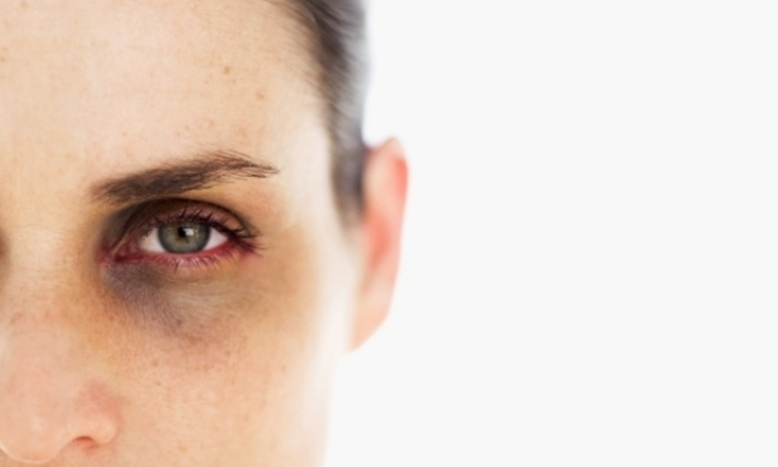 10 Most Effective Tips to Get Rid of Dark Circles