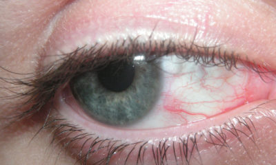 Red Spot on Eyes - Causes and Treatment