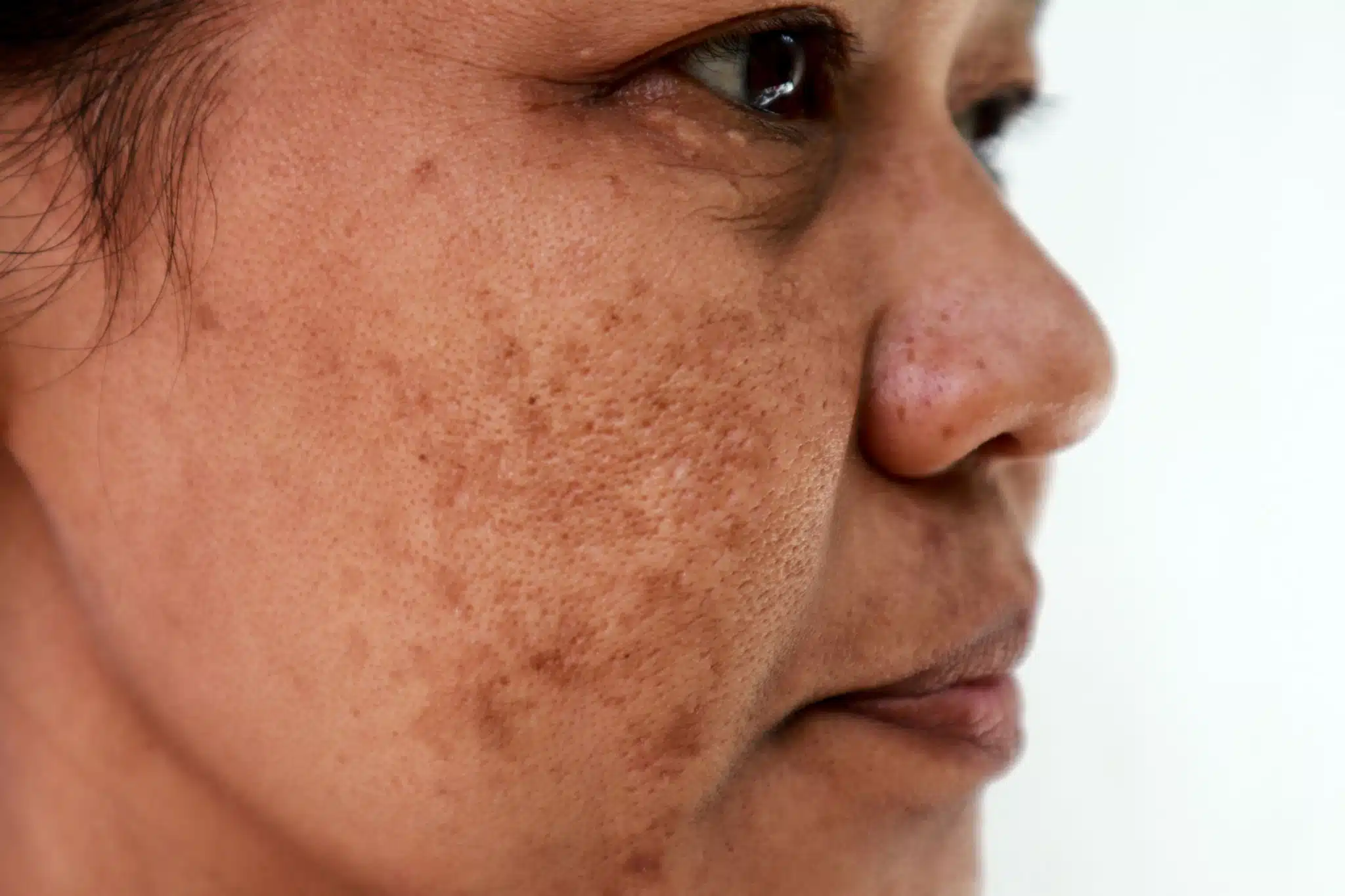 Frequently Asked Questions About Melasma Tratamiento